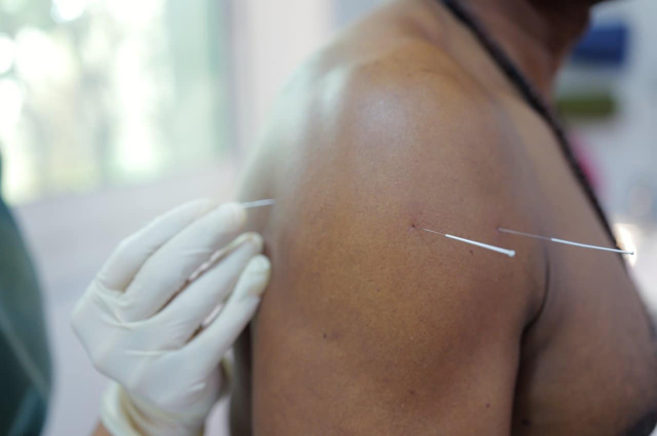 Physiotherapy Therapist Dry Needling - integrative healthcare treatment at Healers Clinic Dubai